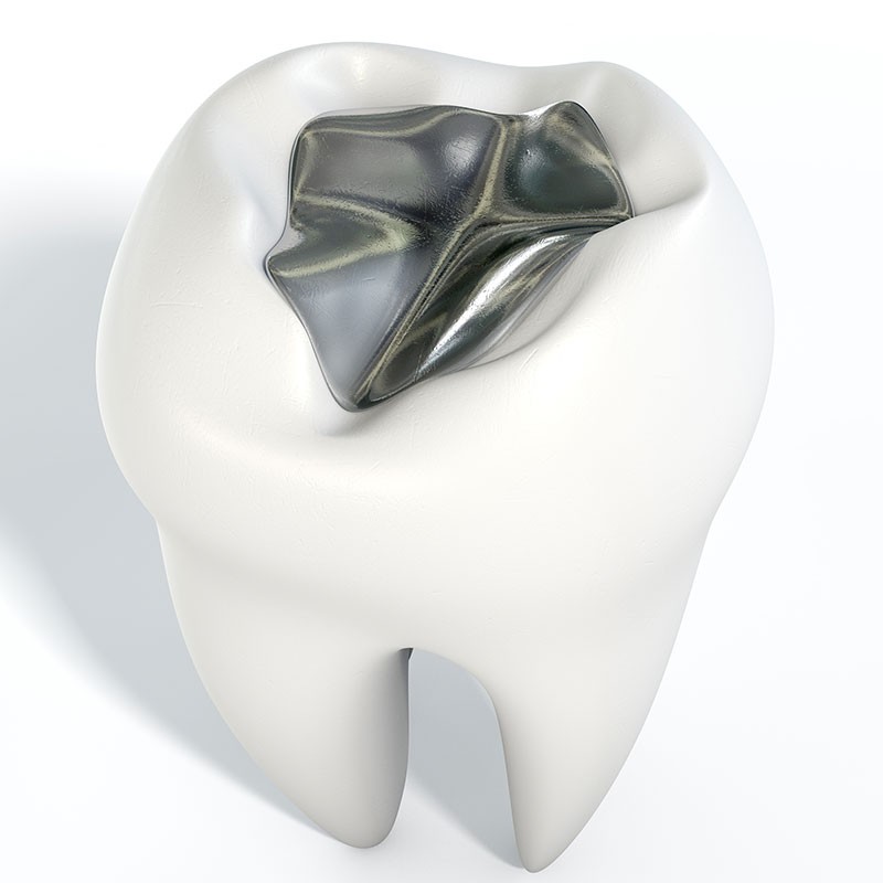 Füllungstherapie Jennersdorf, Güssing